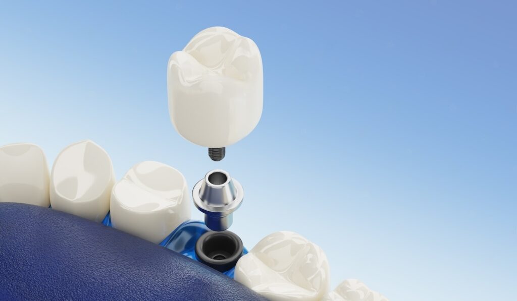 Fabricante de prótesis dentales​